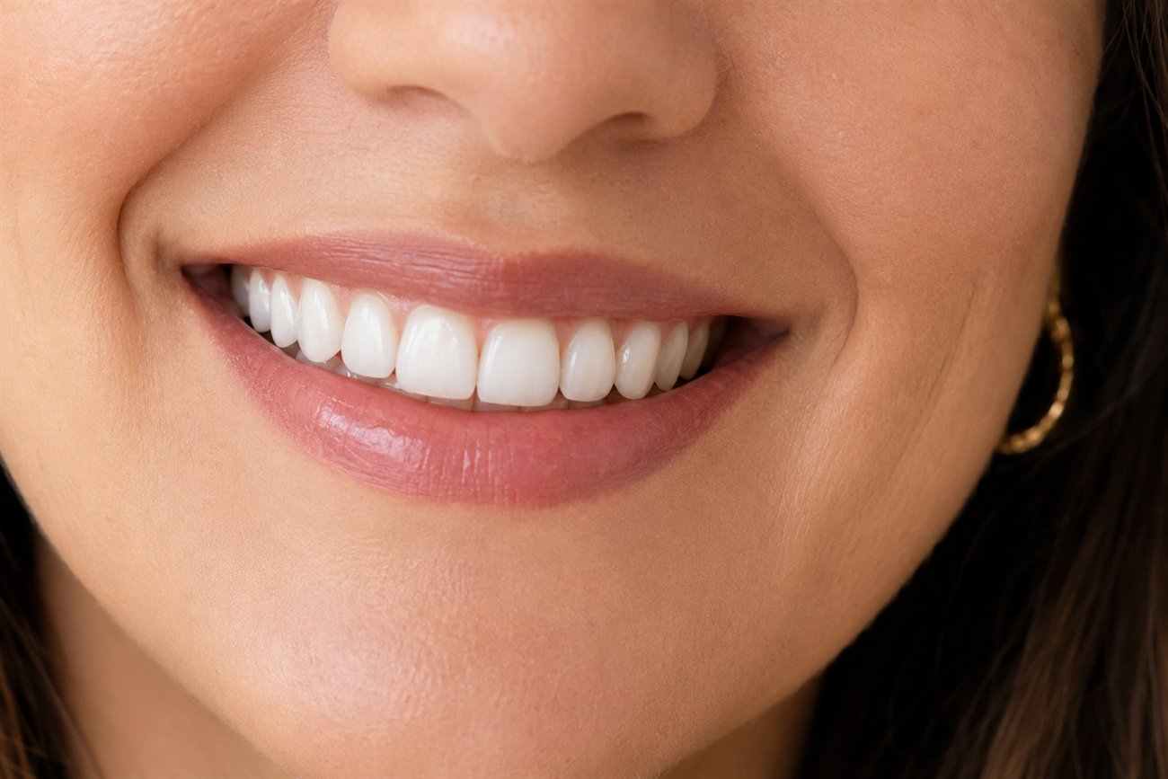 Resultado ilustrativo de diseño de sonrisa natural